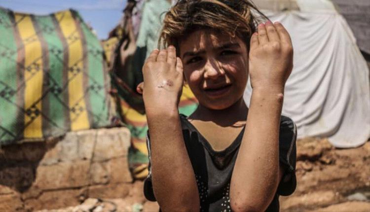الليشمانيا.. جائحة وبائية تصيب نحو 15 ألف شخص في مناطق جماعة الحوثي