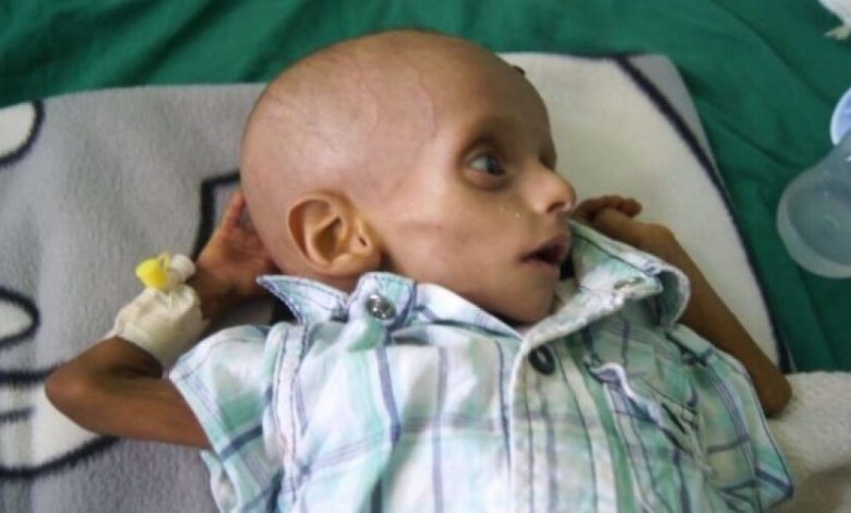 أطفال اليمن ضحايا الجوع والخوف