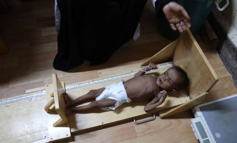 الصحة العالمية: ارتفاع عدد وفيات الدفتيريا في اليمن إلى 34