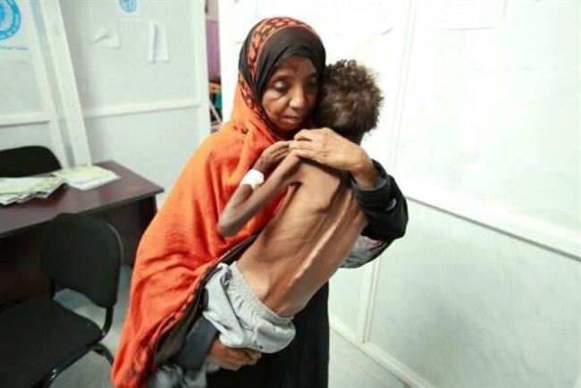 الأمم المتحدة: نصف مليون طفل يمني يواجهون خطر سوء التغذية